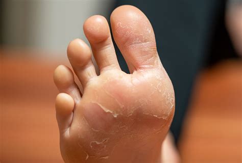One of the most basic solutions is to soak feet for long enough to soften the dead skin and scrub it off with a pumice stone or <strong>foot</strong> brush. . What happens if you leave a foot peel on overnight